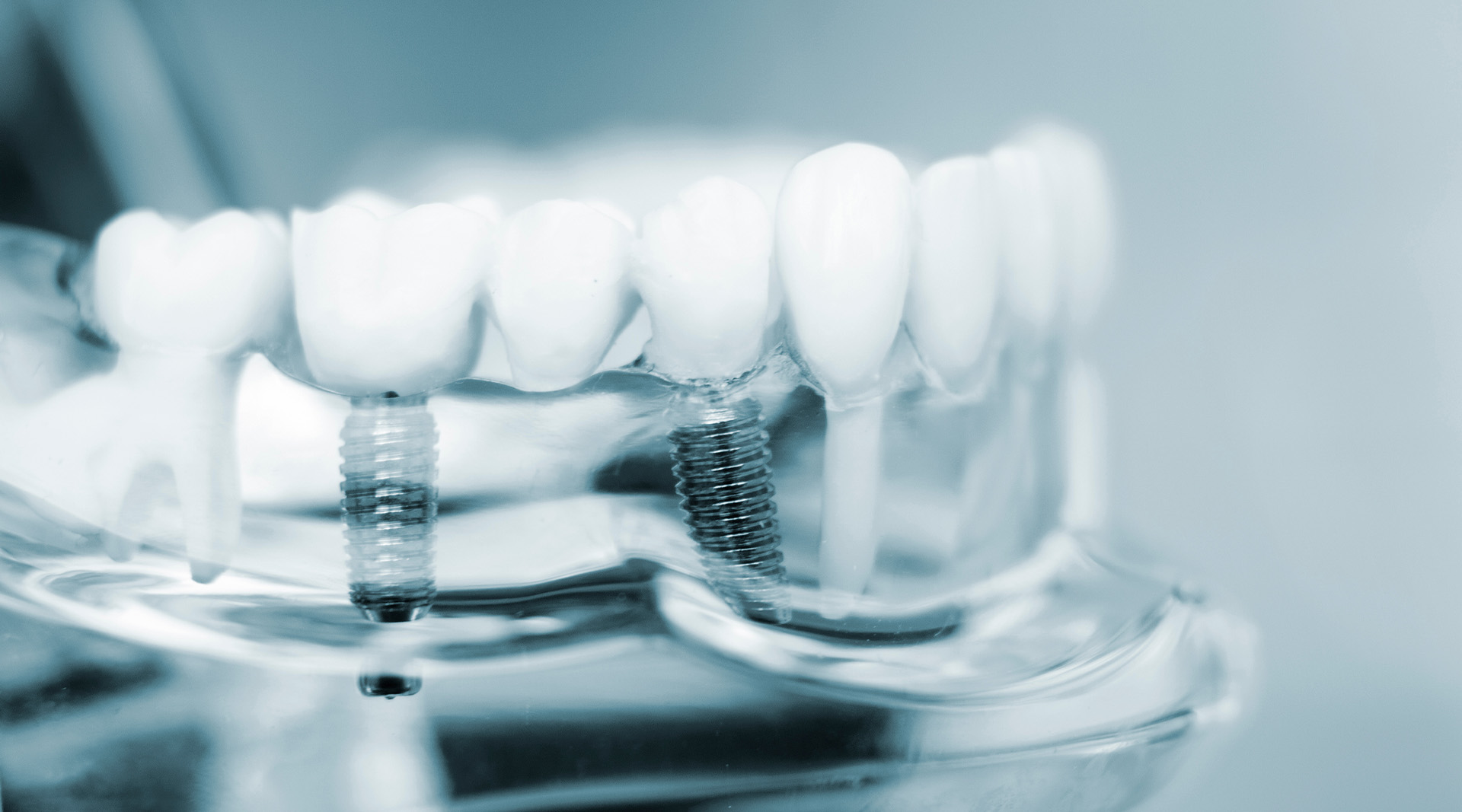 dental implants hero image